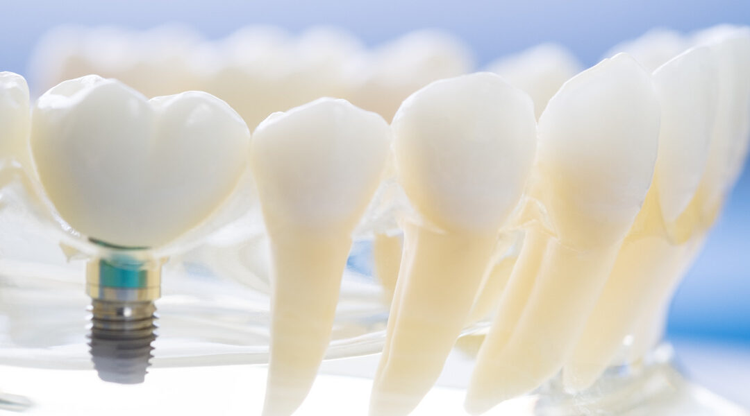 ¿Vas a ponerte un implante dental? Lo que debes saber