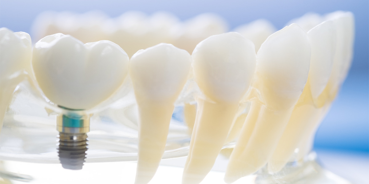 Todo lo que debes saber de implantes dentales en Sevilla