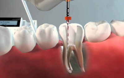Qué es una endodoncia y para qué sirve