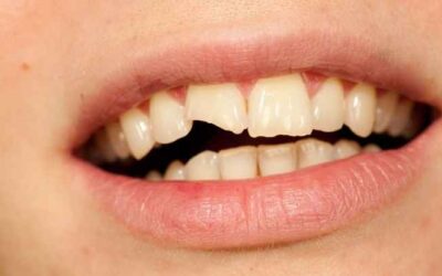 Golpe en los dientes: qué hacer y qué tener en cuenta