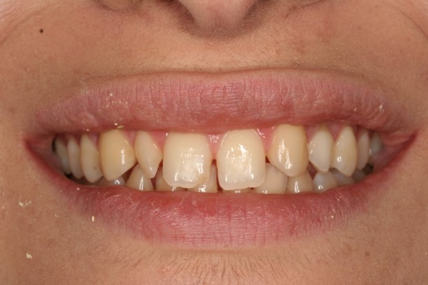 tratamiento-dental-antes-despues-cas-2-antes