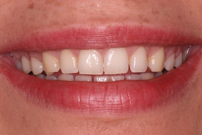 tratamiento-dental-antes-despues-cas-3-antes