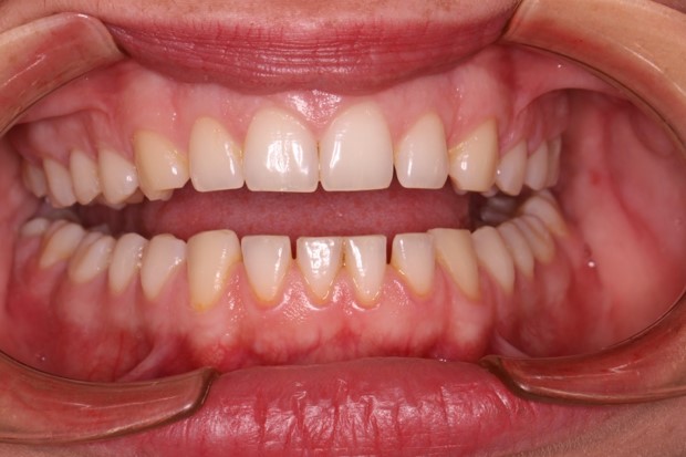 tratamiento-dental-antes-despues-cas-3-antes1