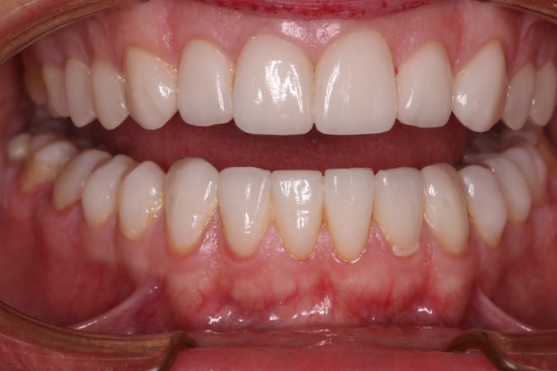 tratamiento-dental-antes-despues-cas-3-despues1