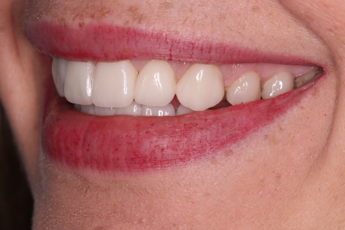 tratamiento-dental-antes-despues-cas-3-despues2