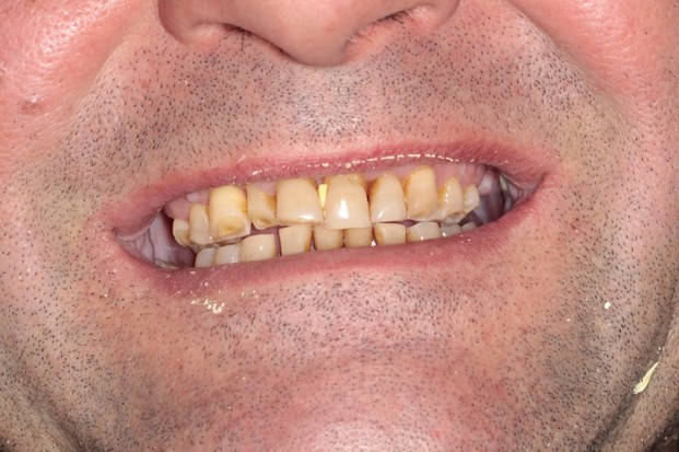 tratamiento-dental-antes-despues-cas-16-antes