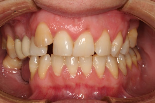 tratamiento-dental-antes-despues-cas-5-antes