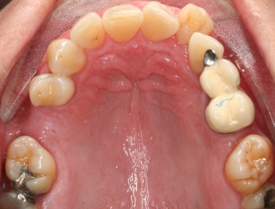 tratamiento-dental-antes-despues-cas-5-antes3