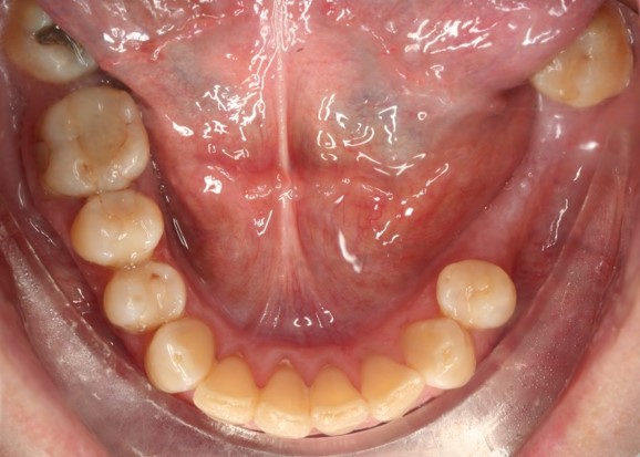 tratamiento-dental-antes-despues-cas-5-antes4