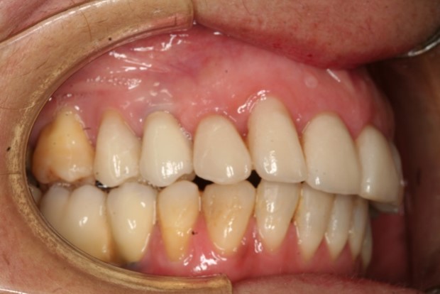 tratamiento-dental-antes-despues-cas-5-despues2
