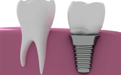 Implante dental que se mueve