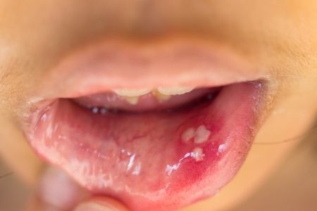 llagas-en-la-lengua-y-encia-tratamiento