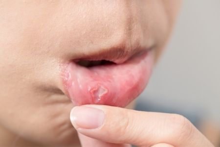 Aftas del bebé o llagas en la boca: qué hacer