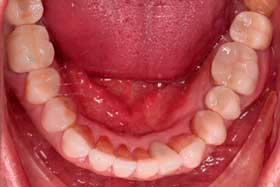 Estética dental sevilla incrustaciones