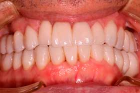 Estética dental sevilla corona