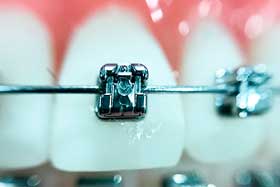 ortodoncia en sevilla brackets metálicos
