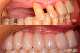 Tipos de implantes dentales 