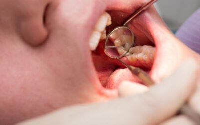 Tratamiento de caries dentales