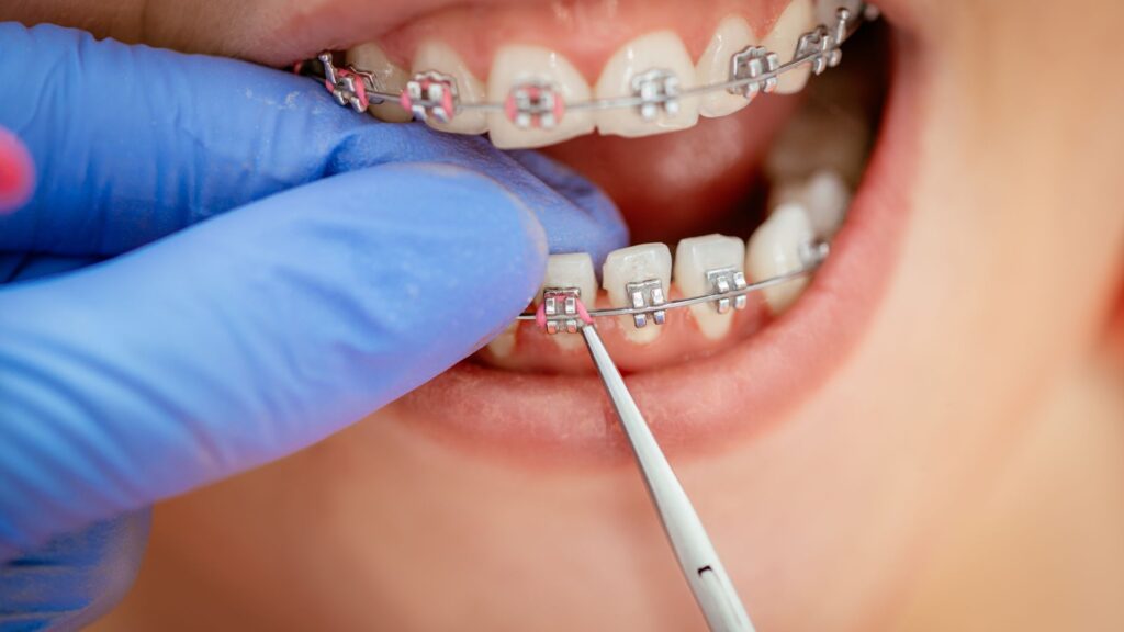 cómo quita el dentista los brackets