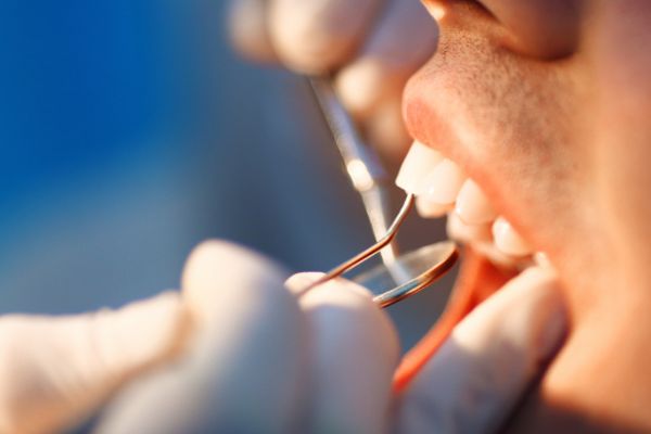 Reconstrucción dental: qué es, tipos y otra información de interés