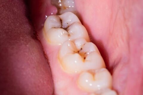Dientes Picados S ntomas Y Tratamiento Sevilla Dental dientes-picados-s-ntomas-y-tratamiento-sevilla-dental