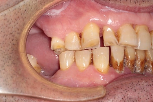 tratamiento-dental-antes-despues-cas-16-antes2 tratamiento-dental-antes-despues-cas-16-antes2