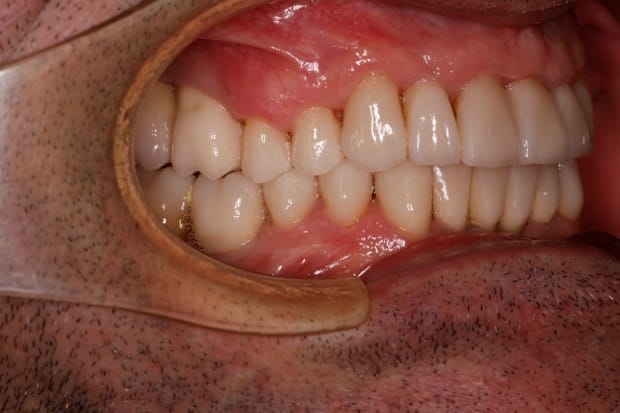 tratamiento-dental-antes-despues-cas-16-despues2 tratamiento-dental-antes-despues-cas-16-despues2