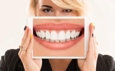 Diseño de sonrisa: cómo conseguir la sonrisa perfecta