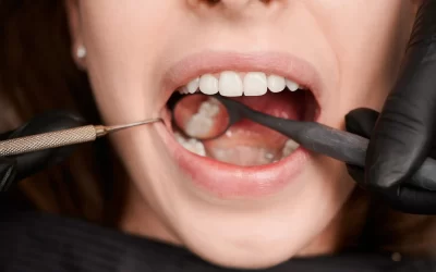 Empaste dental: qué es, proceso y duración